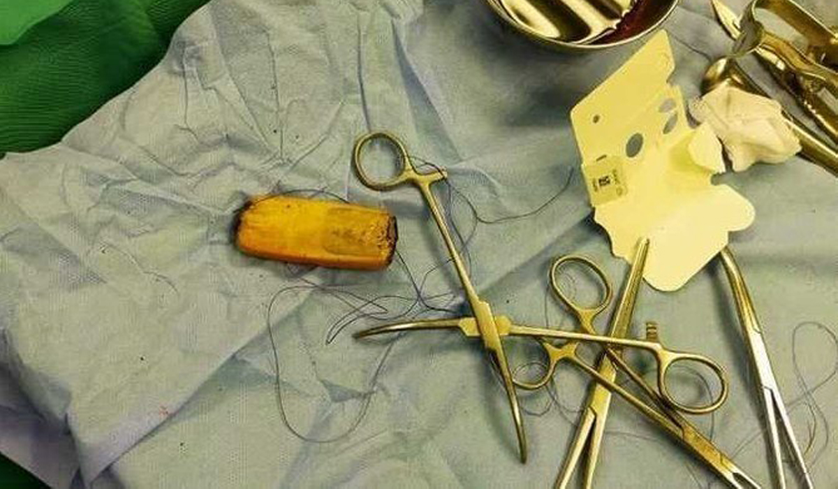 Doctors in Egypt extract mobile phone from patient’s stomach